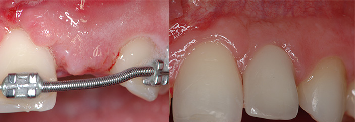 cas1-implant