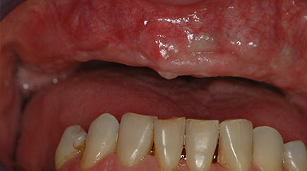 traitements-cas3-avant-implant