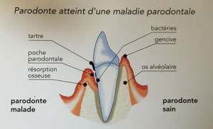 maladie-parodontale