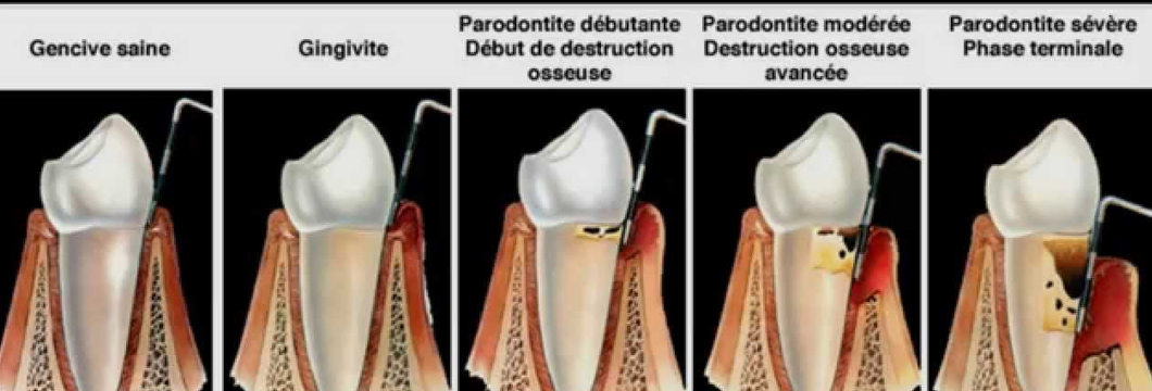 parodonte