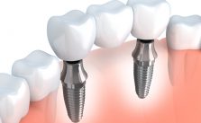 Implant dentaire marseille