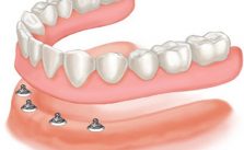 implant-prothese-amovible-dentaire-mattout(2)