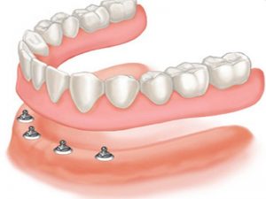 implant-prothese-amovible-dentaire-mattout(2)