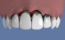 prix-implant-dentaire-mattout(6)