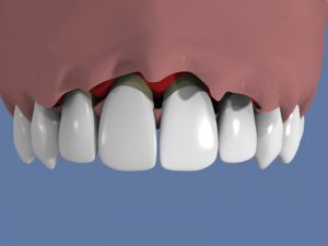 prix-implant-dentaire-mattout(6)