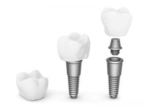 implant-dentaire-marseille-10eme