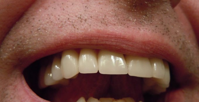 Calmer une rage de dents